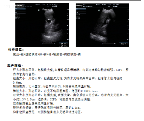 真性脾破裂超声图片图片