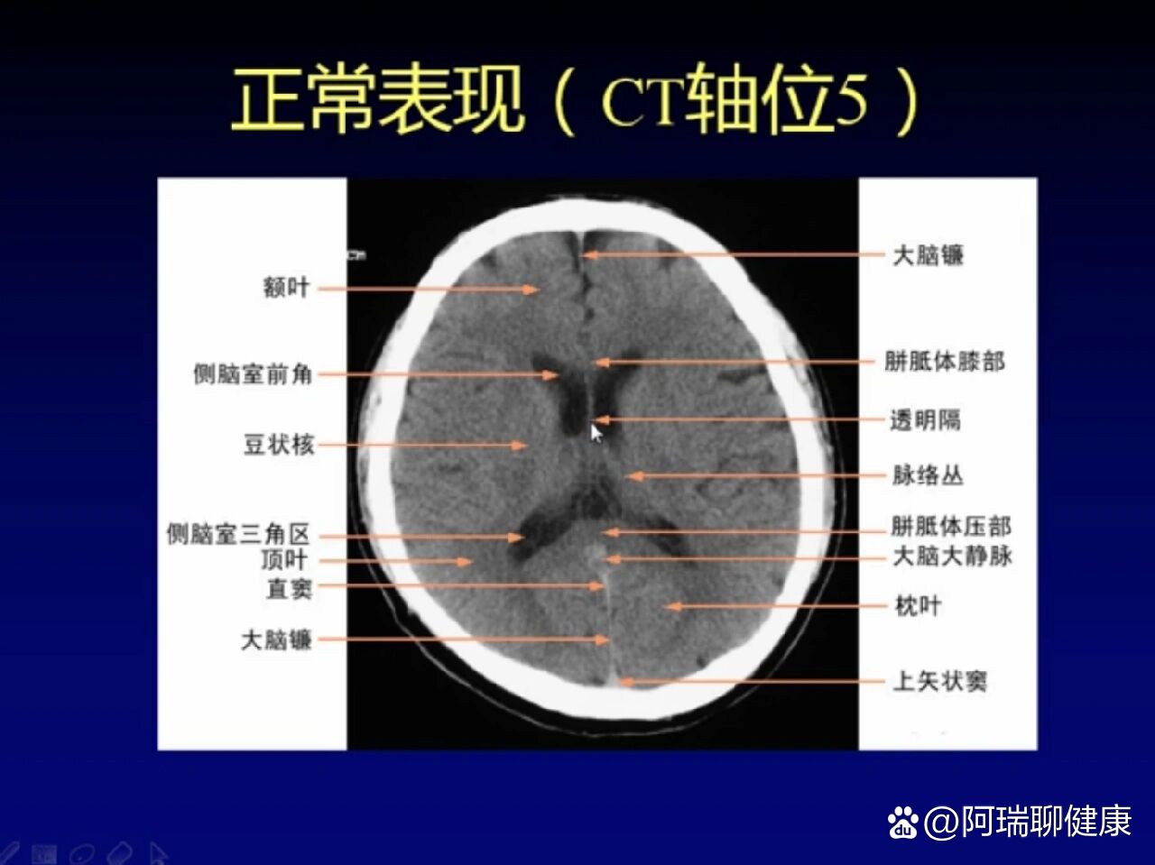 正常脑部ct影像图