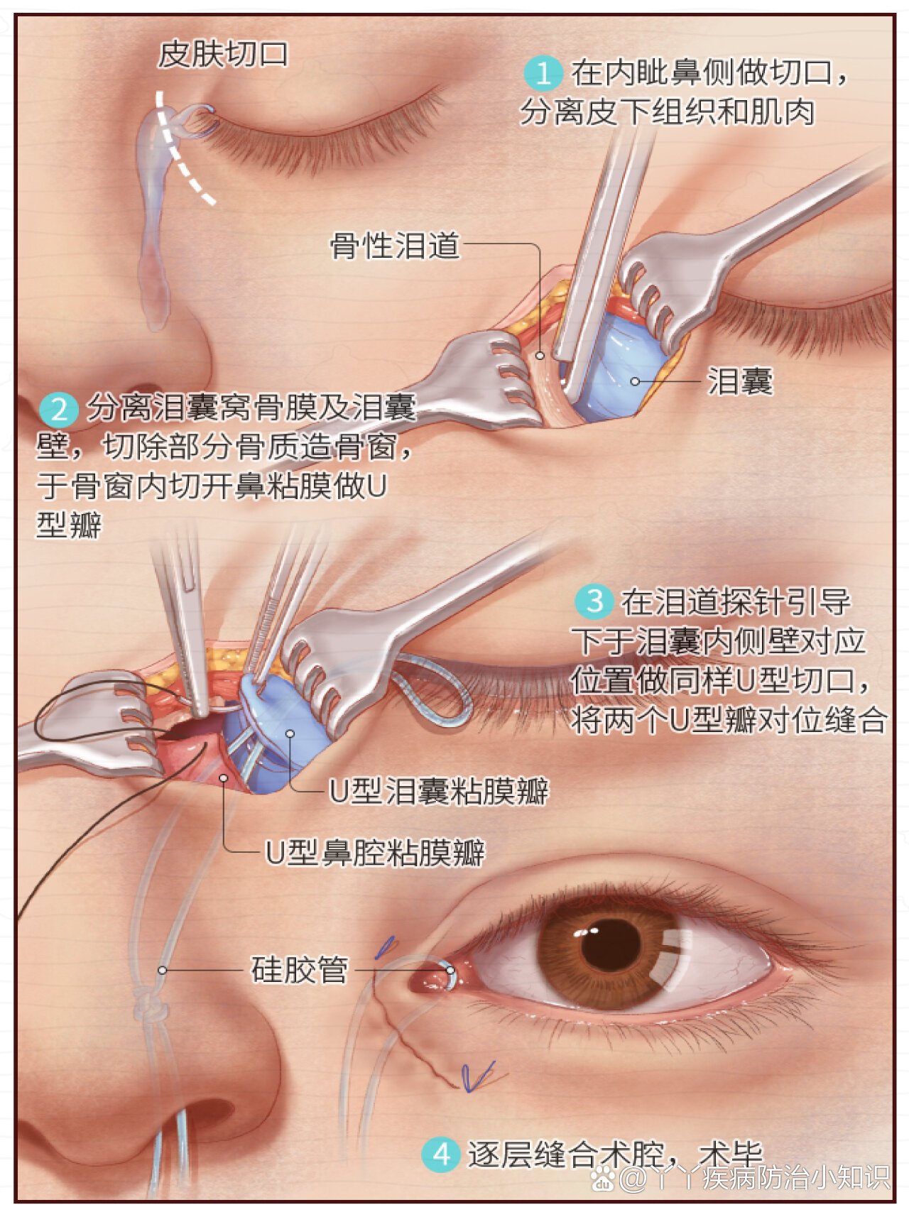 93泪囊鼻腔吻合术90