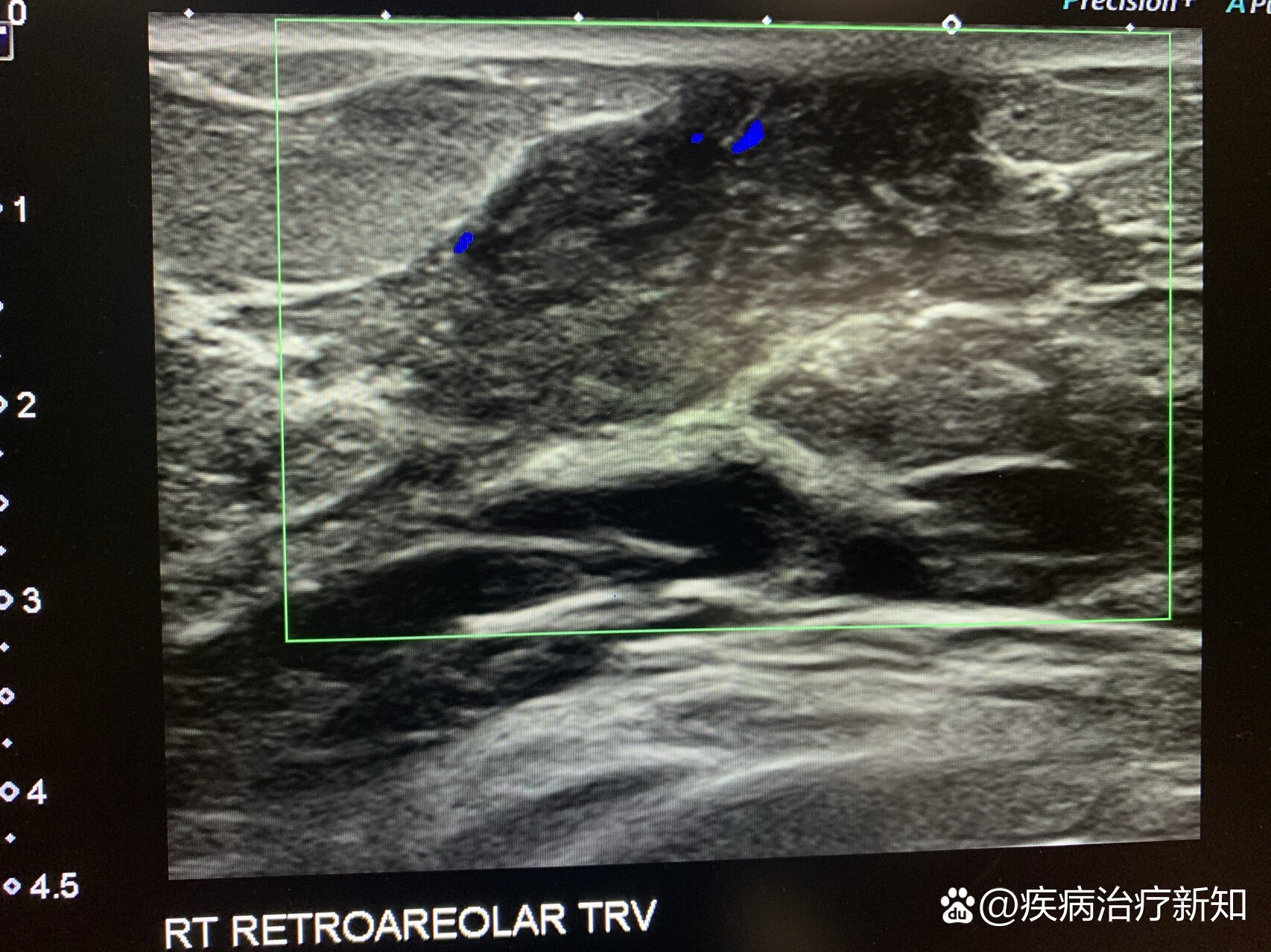 男性乳腺增生图片样子图片