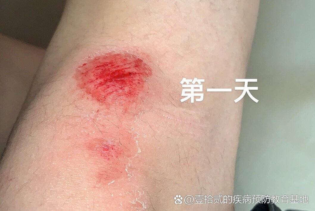 记录一次较为严重的摔伤伤口愈合过程