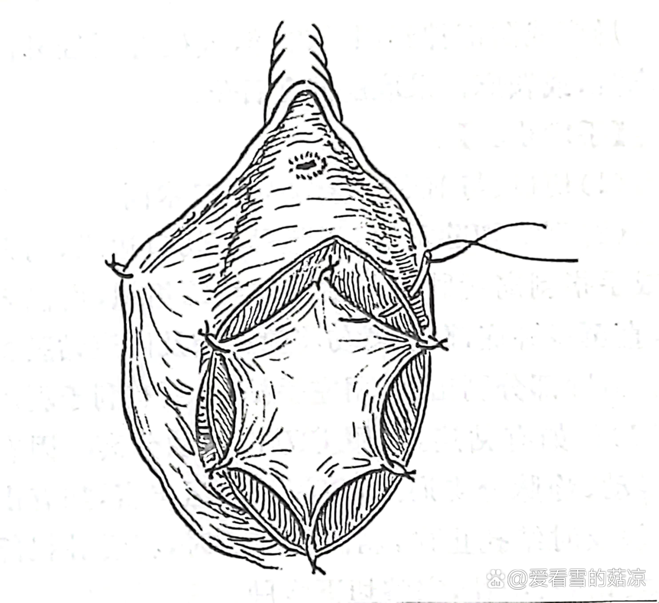 前庭大腺囊肿手术图解图片