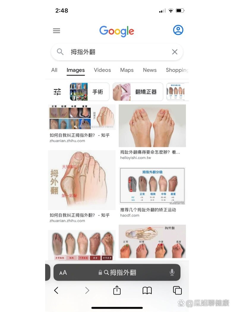 拇指外翻足内翻,矫正鞋垫有用吗