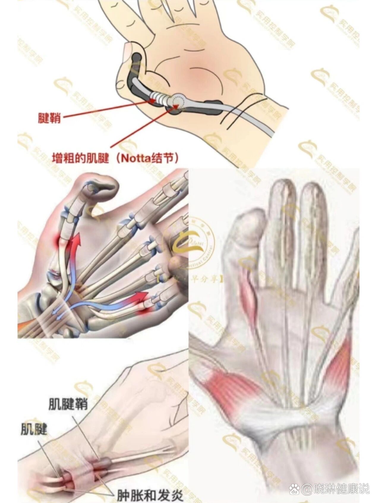 腱鞘分布图图片