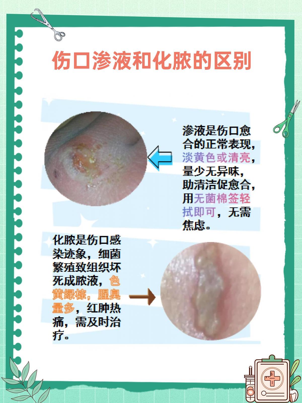 伤口渗液VS化脓，别再傻傻分不清！