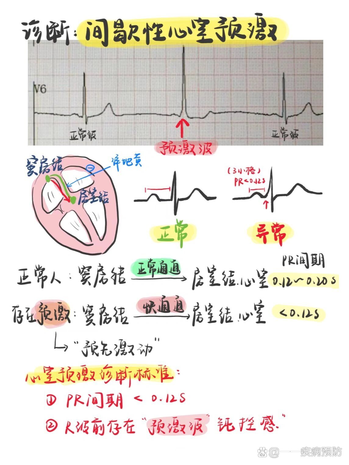 A型预激综合征图片