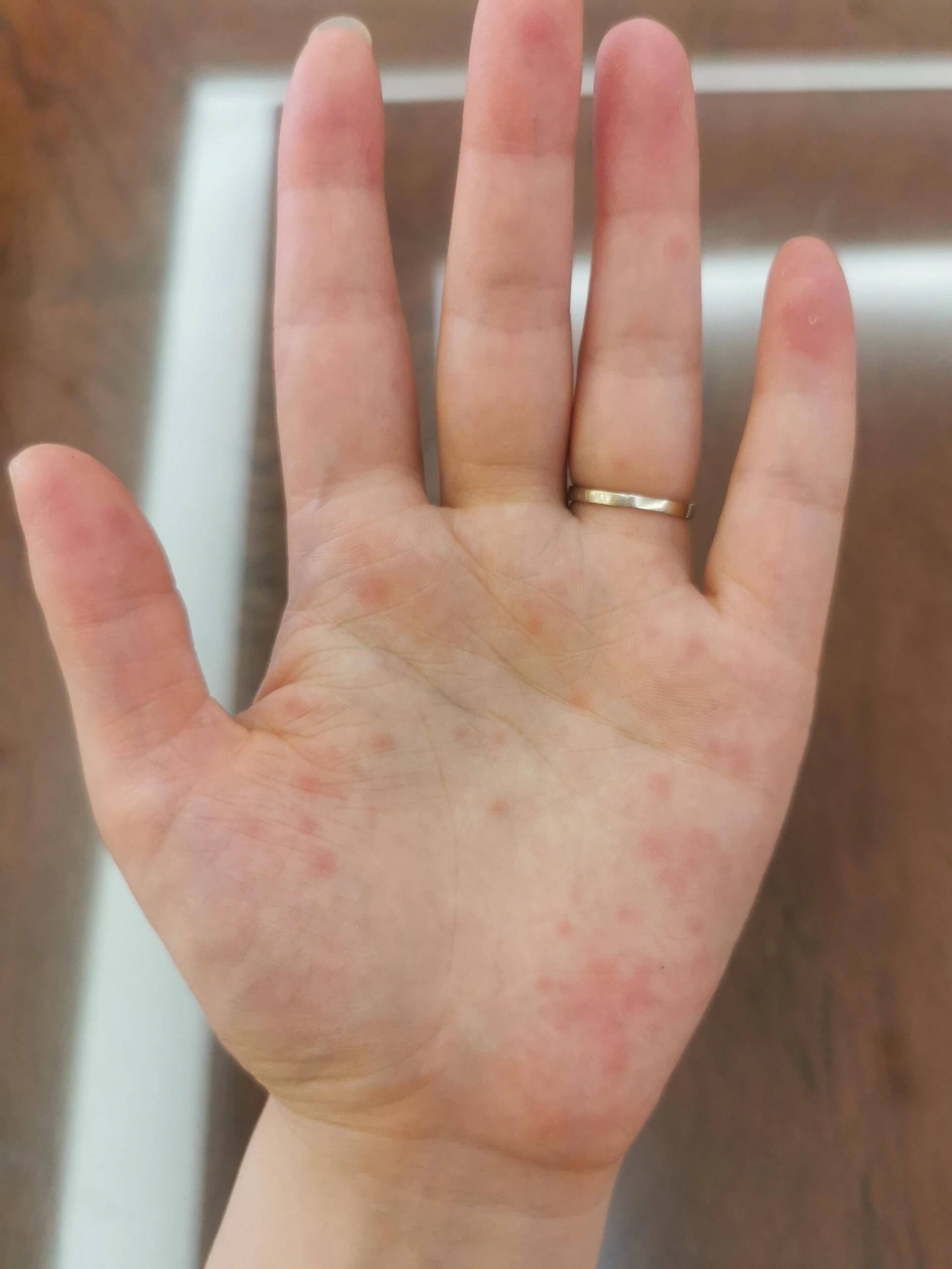 手心为啥起了红点点,还不痒