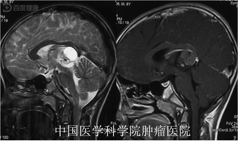 松果体区畸胎瘤图片