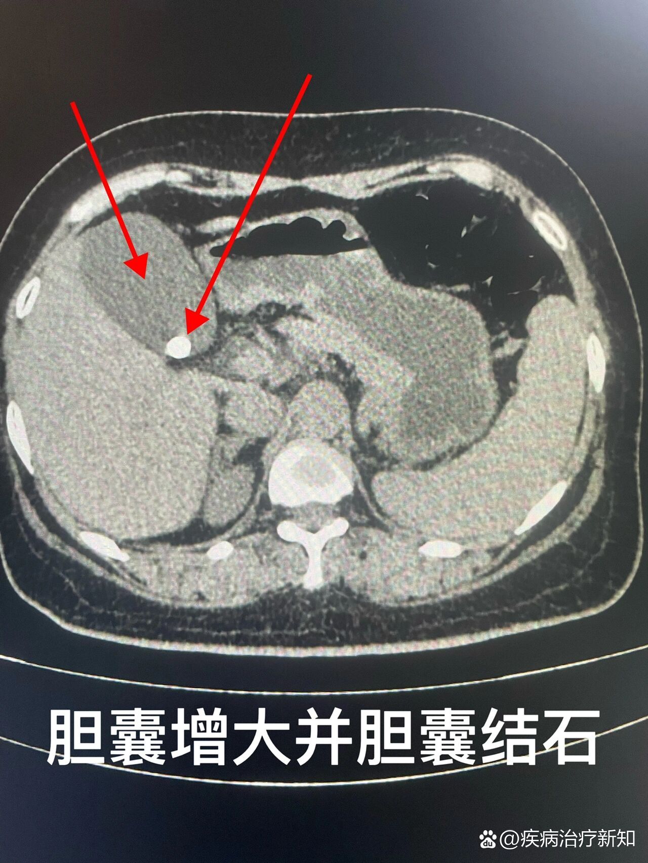 胆系结石(上腹部ct平扫)胆囊