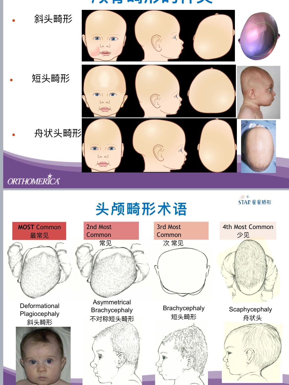 枕部扁平图片