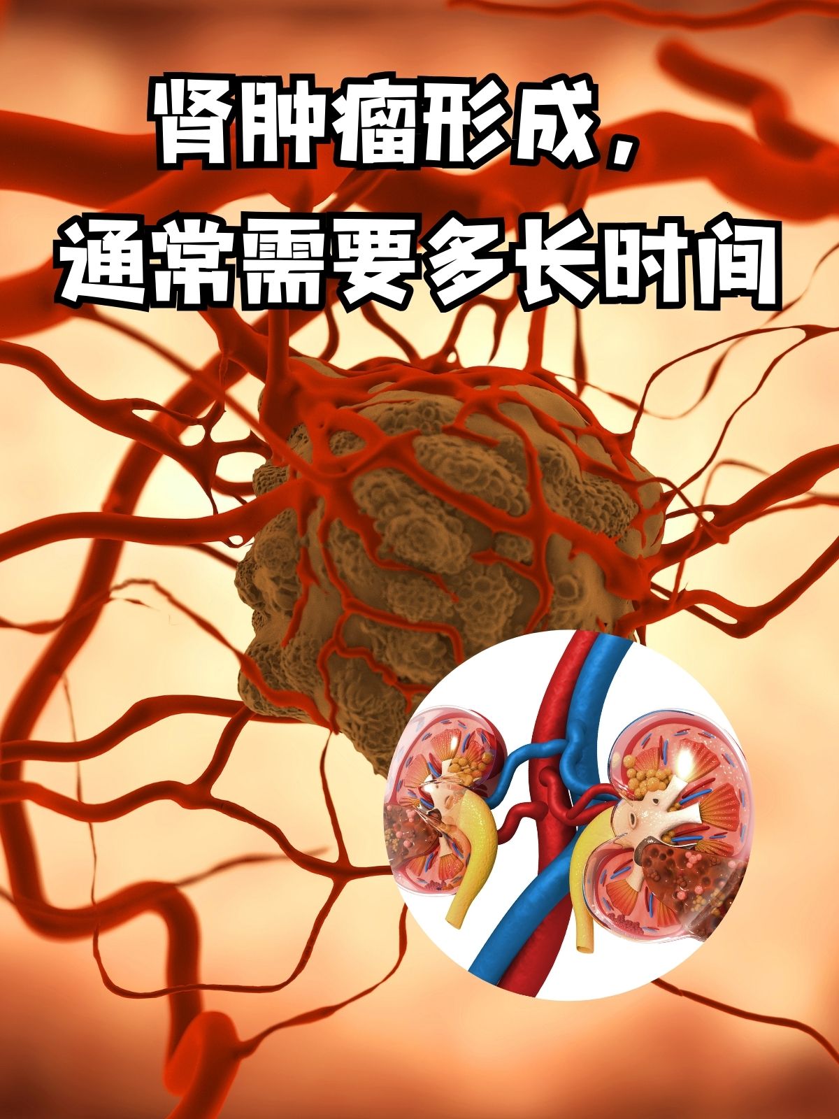 肾肿瘤形成,通常需要多长时间?