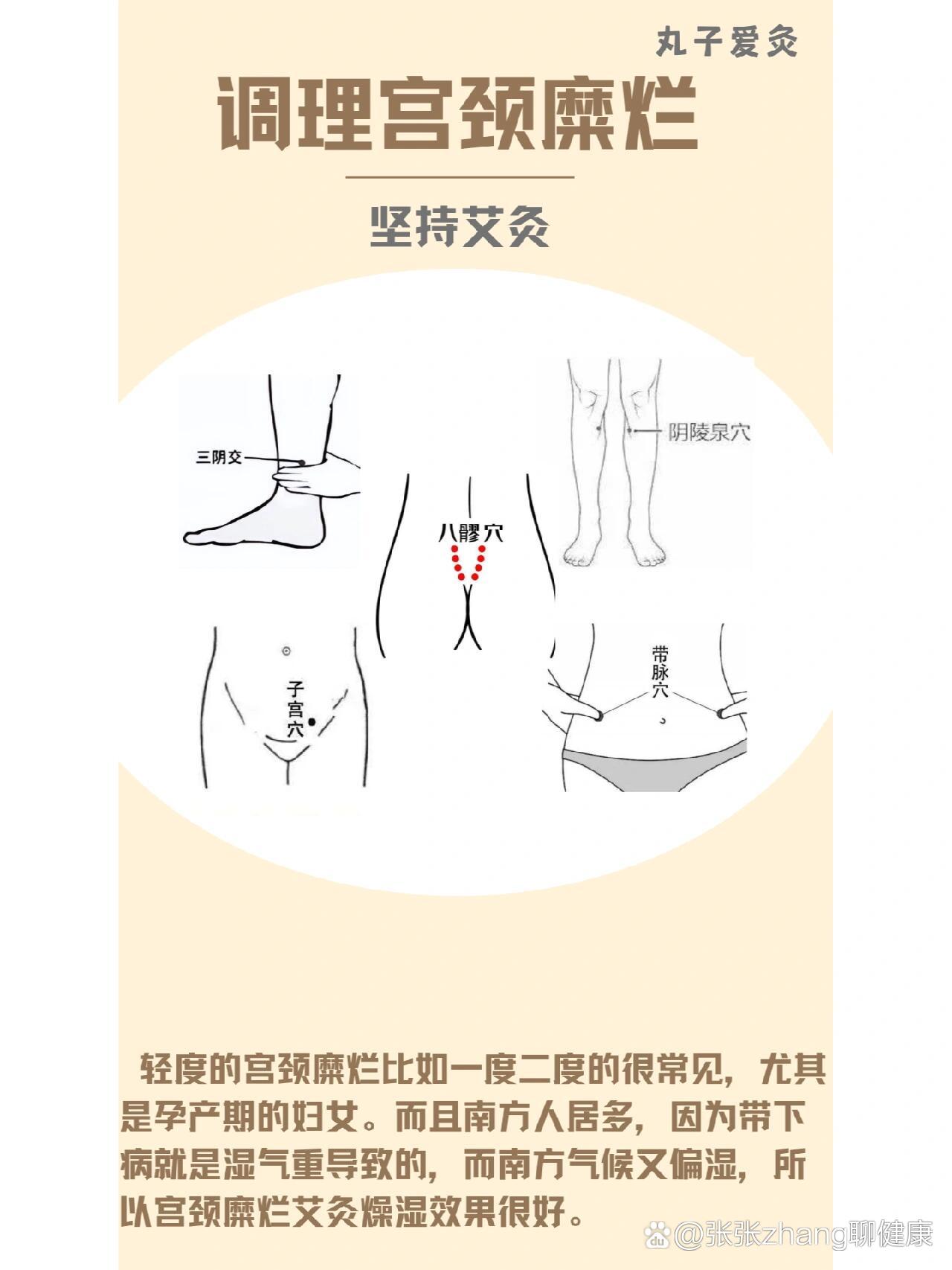 调理宫颈糜烂艾灸穴位