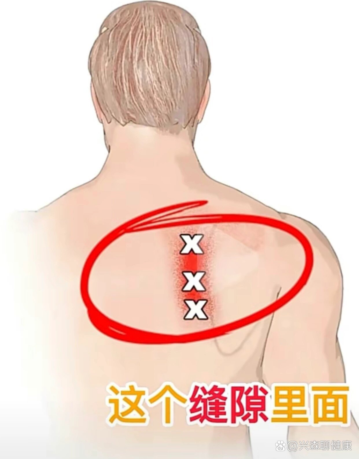 肩胛背神经卡压综合征