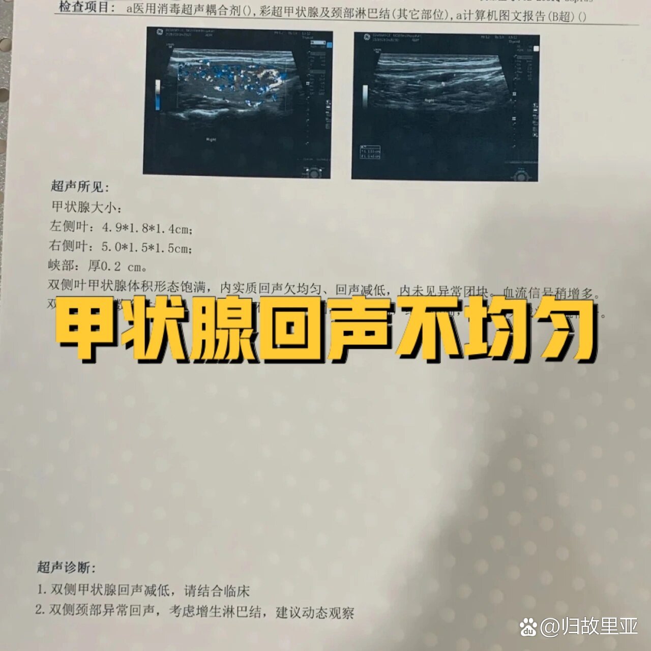 只提示有回声不均匀现象,那那极有可能是桥本氏甲状腺炎