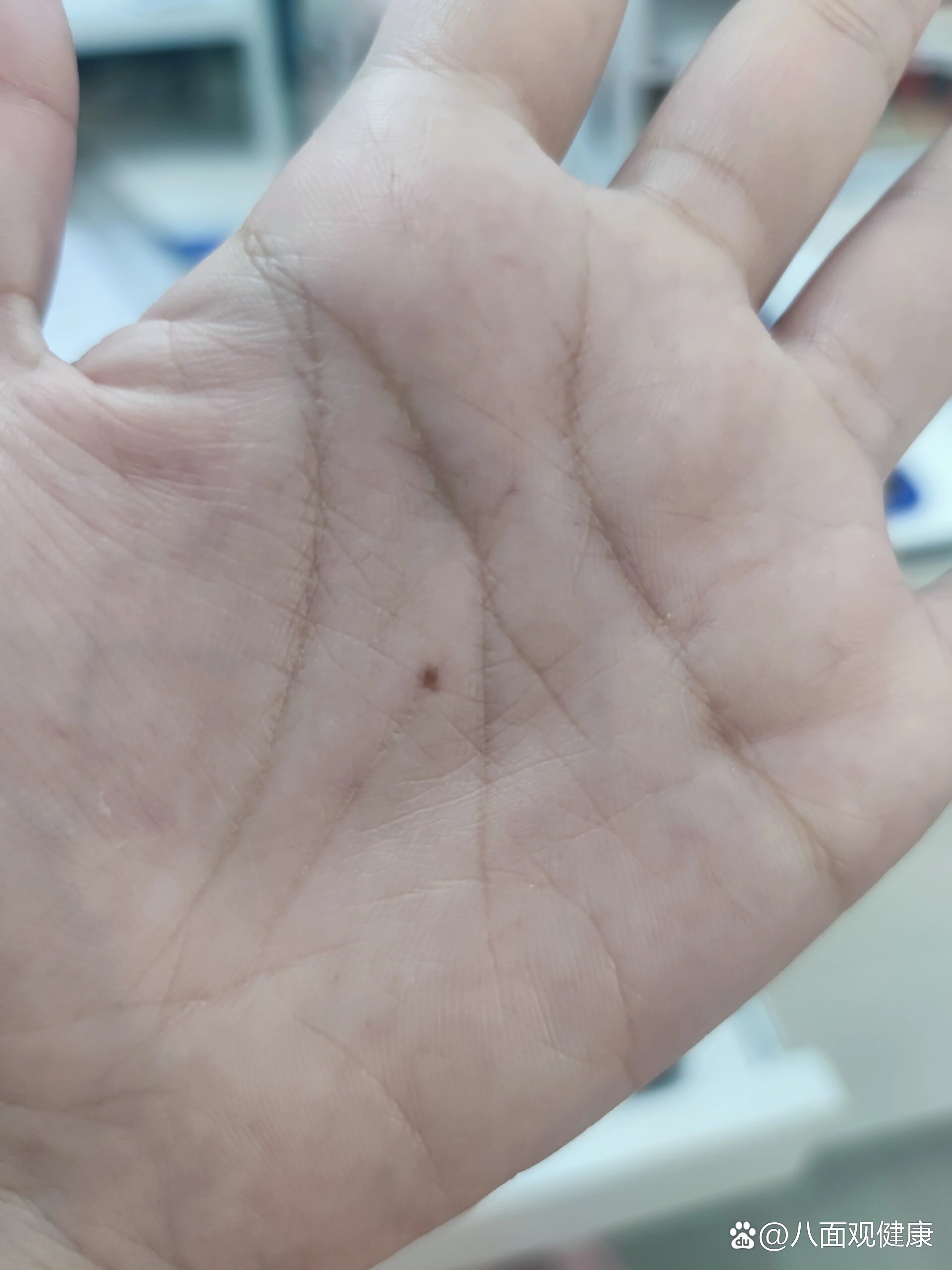 请问这个掌心的痣需要去除吗