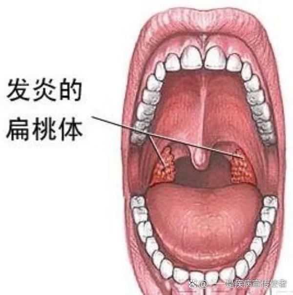 儿童扁桃体疱疹图片图片