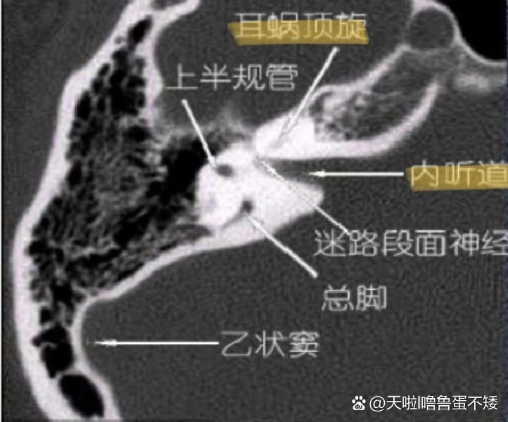 内听道ct解剖图图片