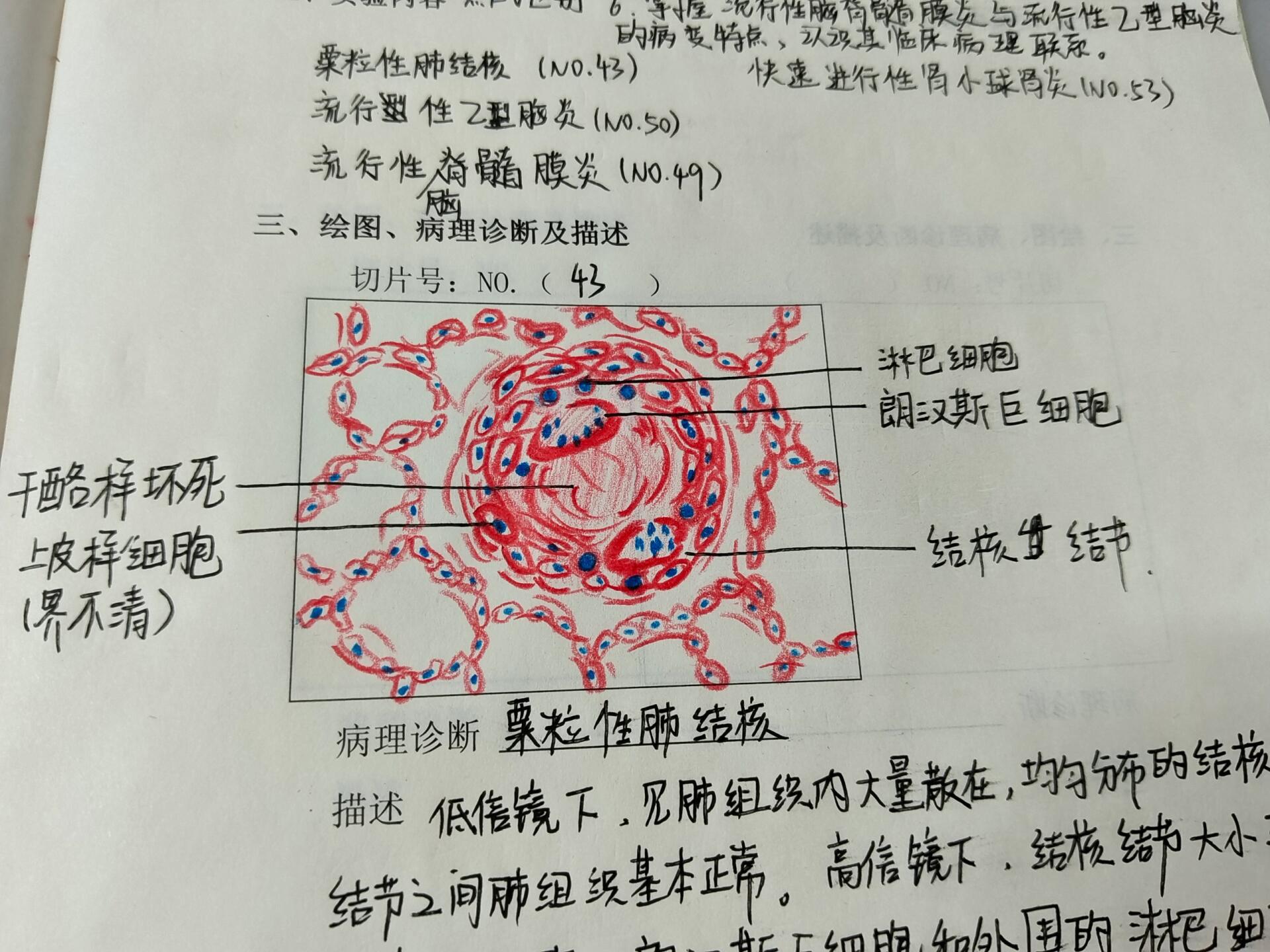 结核结节病理手绘图图片