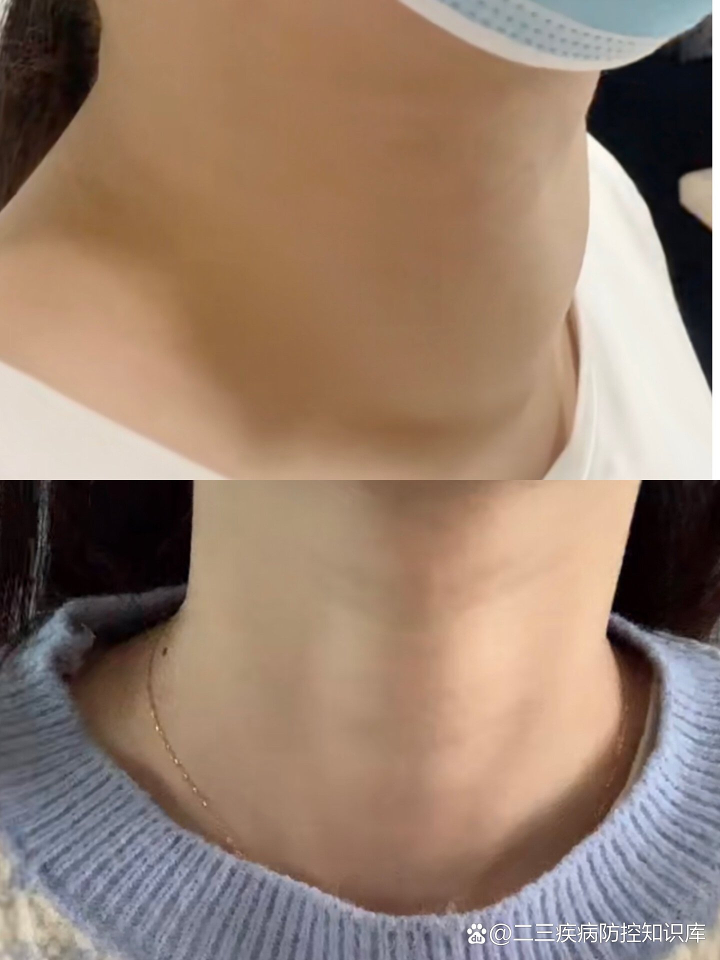 甲亢脖子粗终于恢复了!