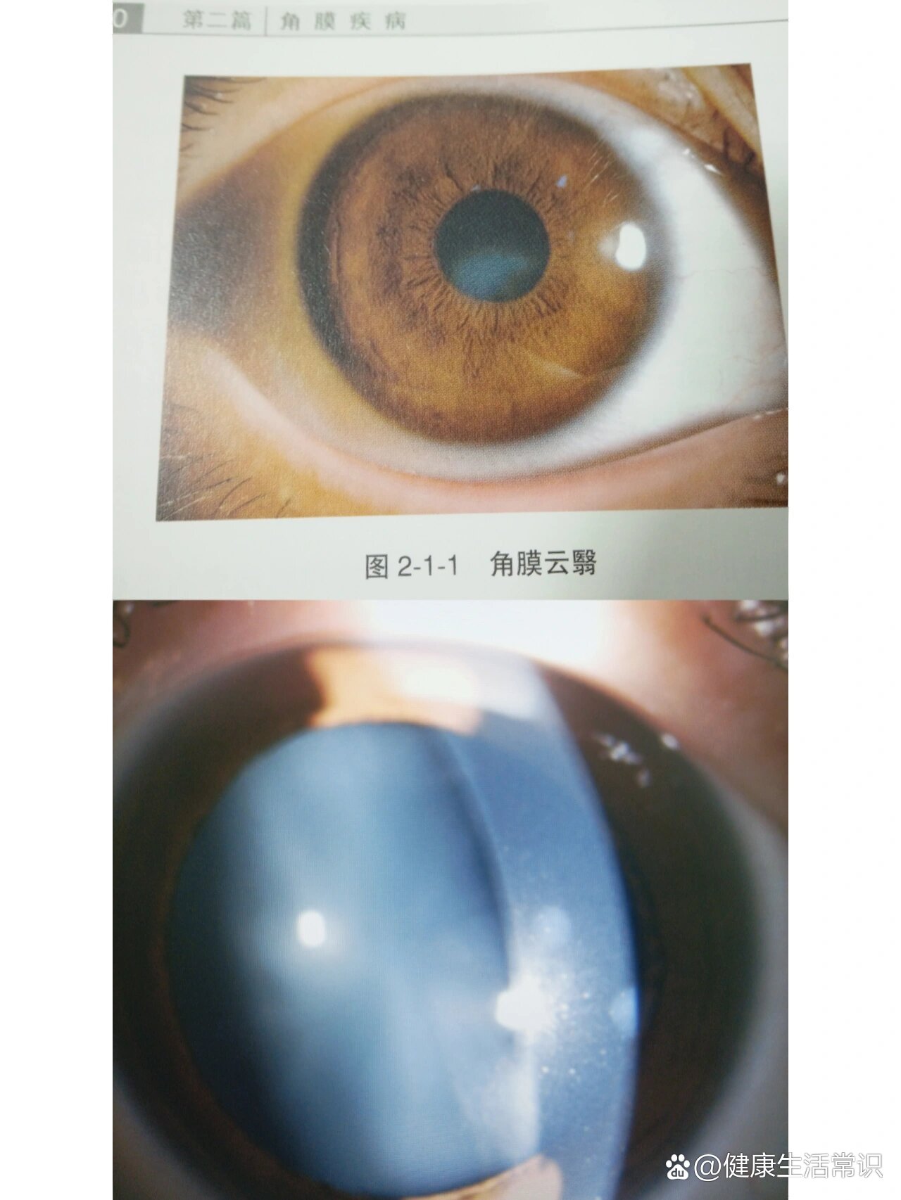 角膜云翳不知道,你还做什么近视手术