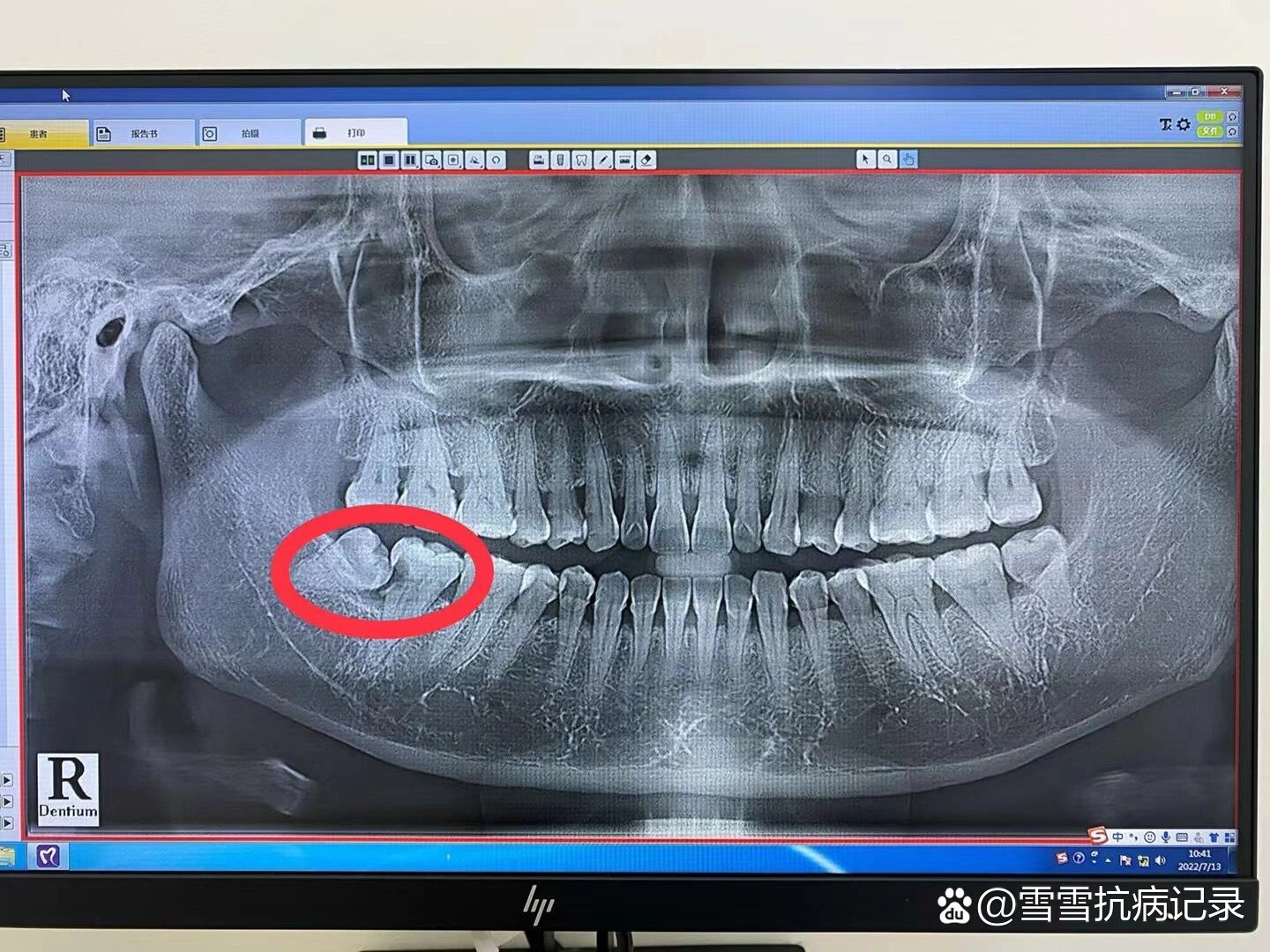 智齿长歪的图片图片