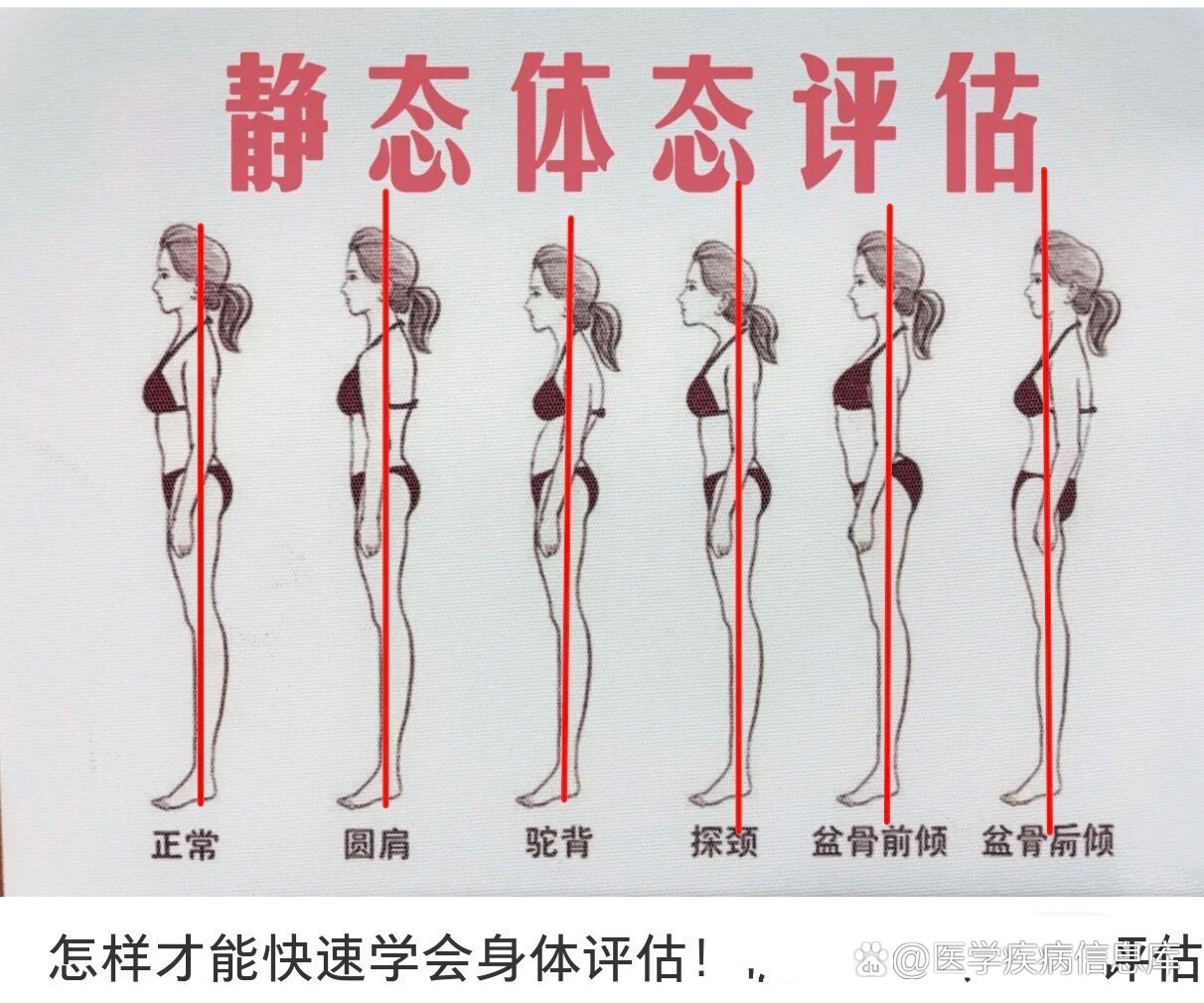 平背-第三种体态异常详解和调整方案!