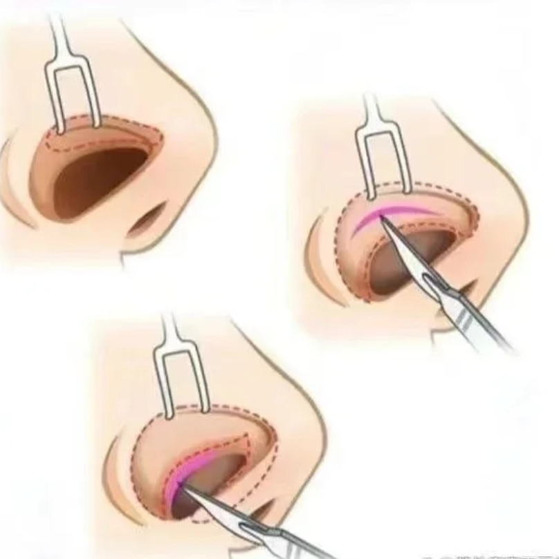 常见的隆鼻手术切口位置有鼻腔内部,鼻翼缘以及鼻孔内侧等