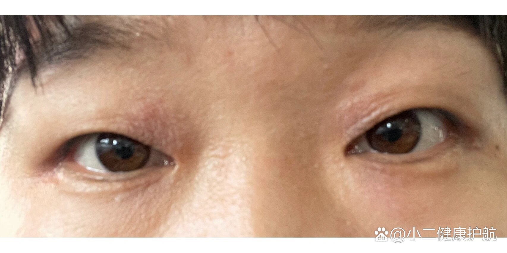 眼睛肿痒脱皮,终于找到方法了