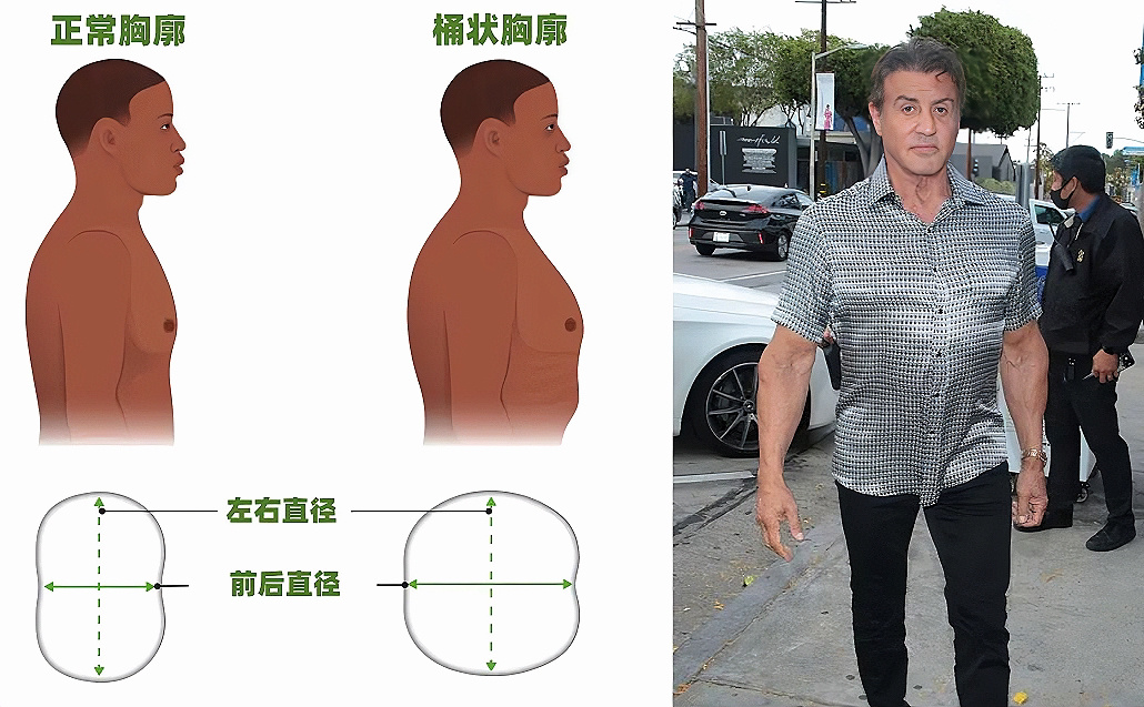 03桶状胸|不同的胸廓外形改变97