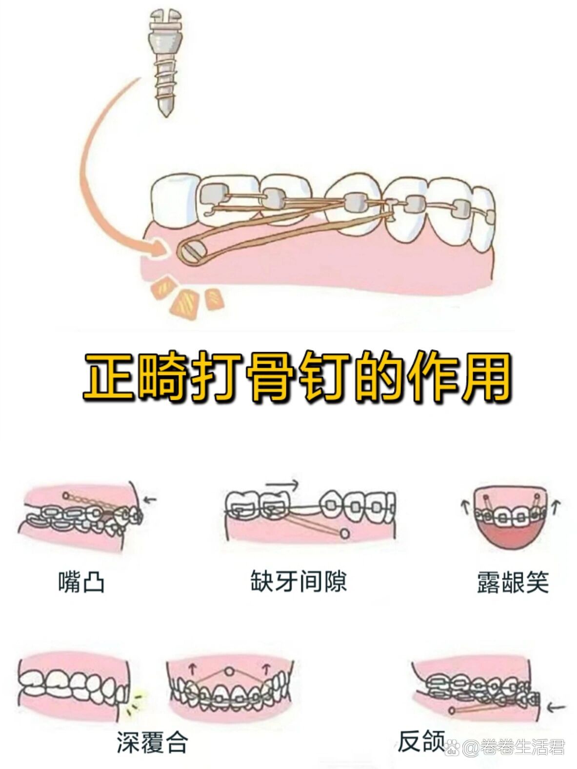 牙齿打骨钉图片