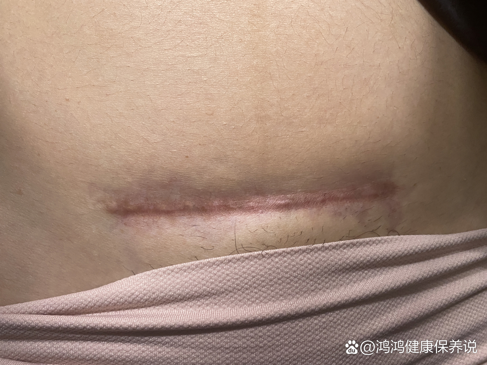 剖腹产疤痕增生-祛疤针前后对比(有图慎入)