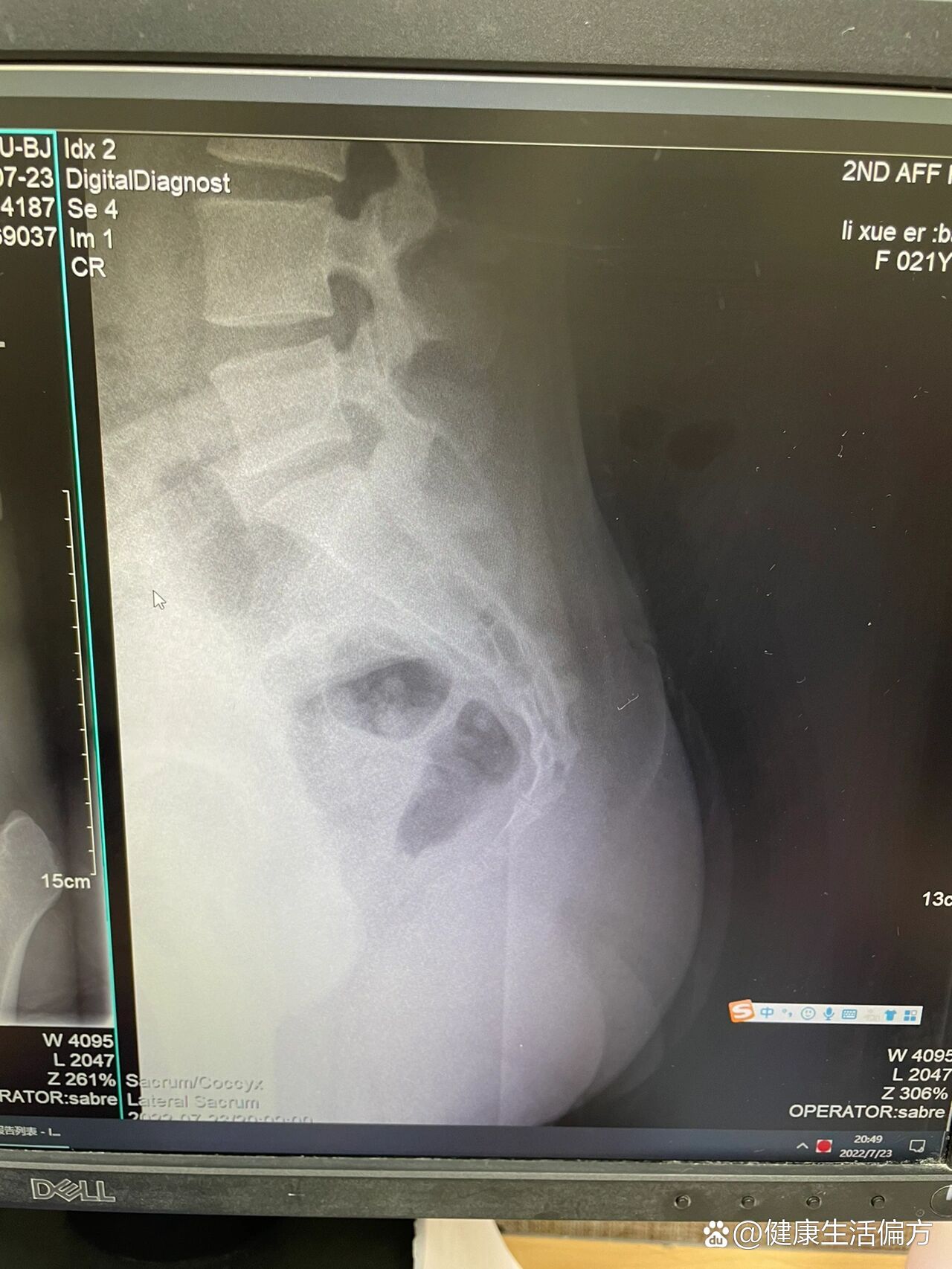 这是尾骨骨裂吗0101