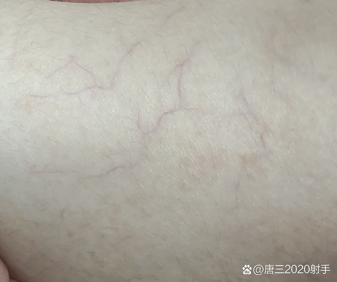 皮肤上出现红血丝,这是什么原因?