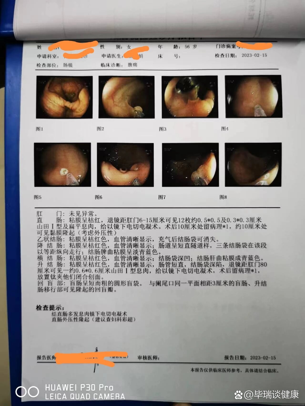 直肠外压隆起是什么情况啊