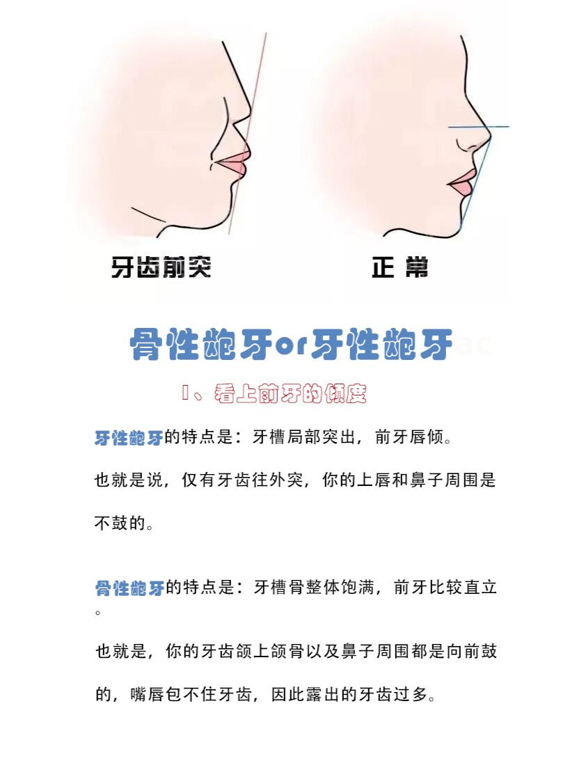 骨性龅牙图图片