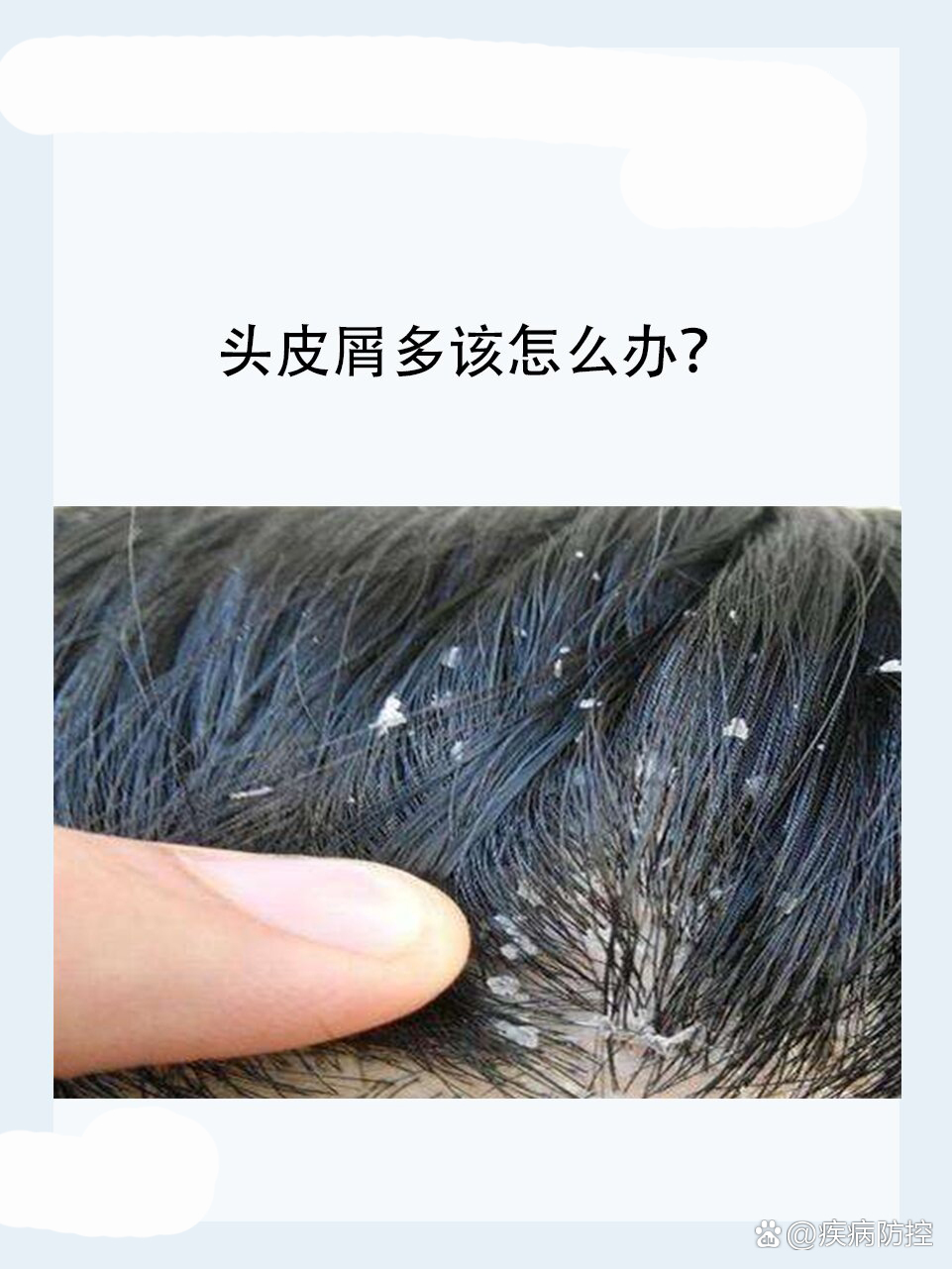 头皮屑多该怎么办?