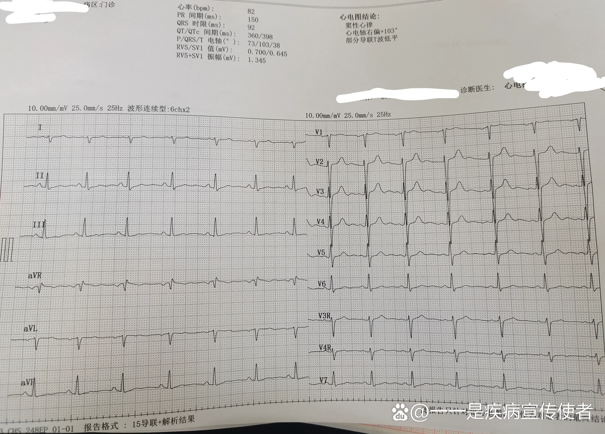心电图t波低平 全网资源
