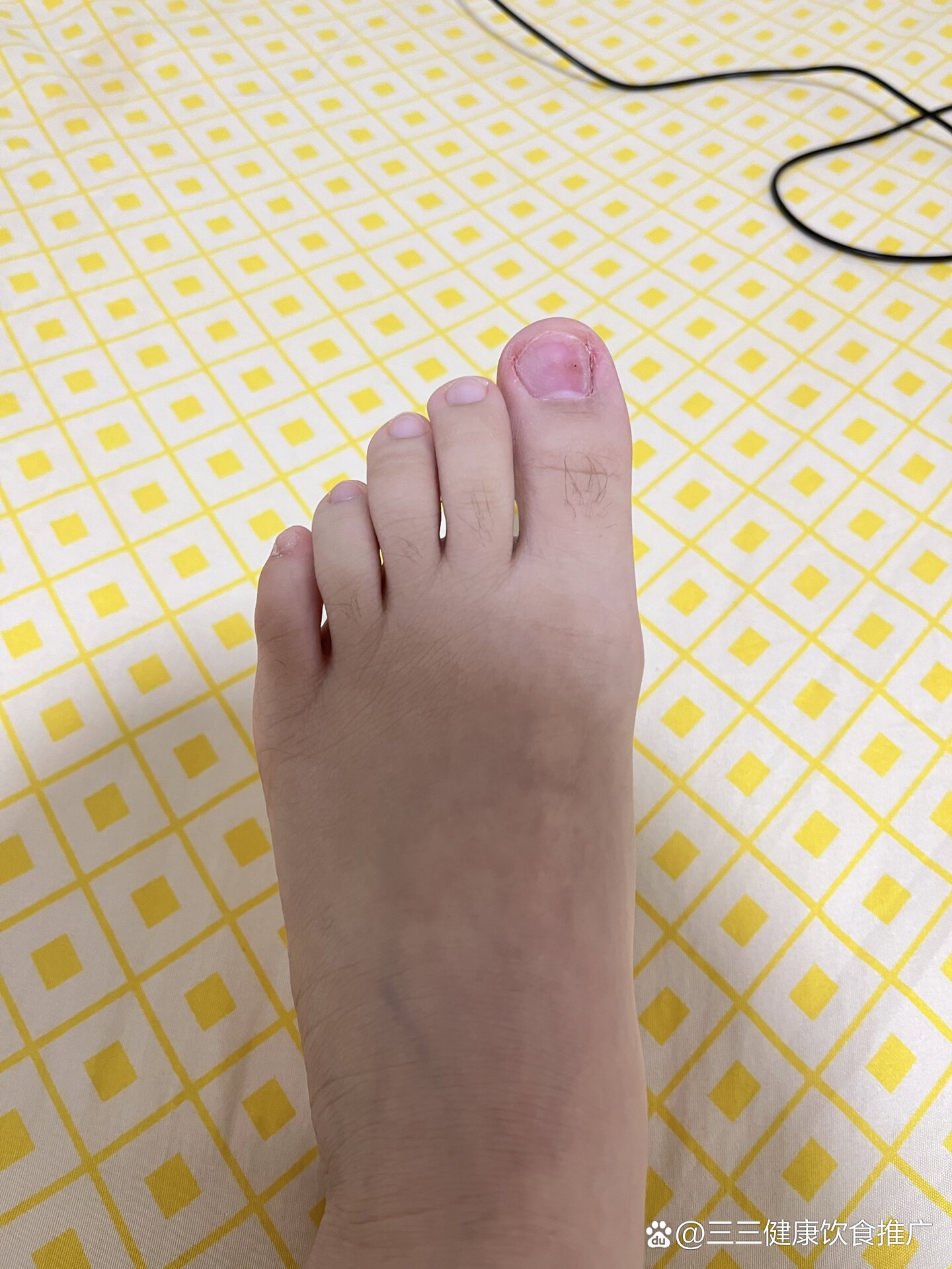 左脚指甲盖有黑点