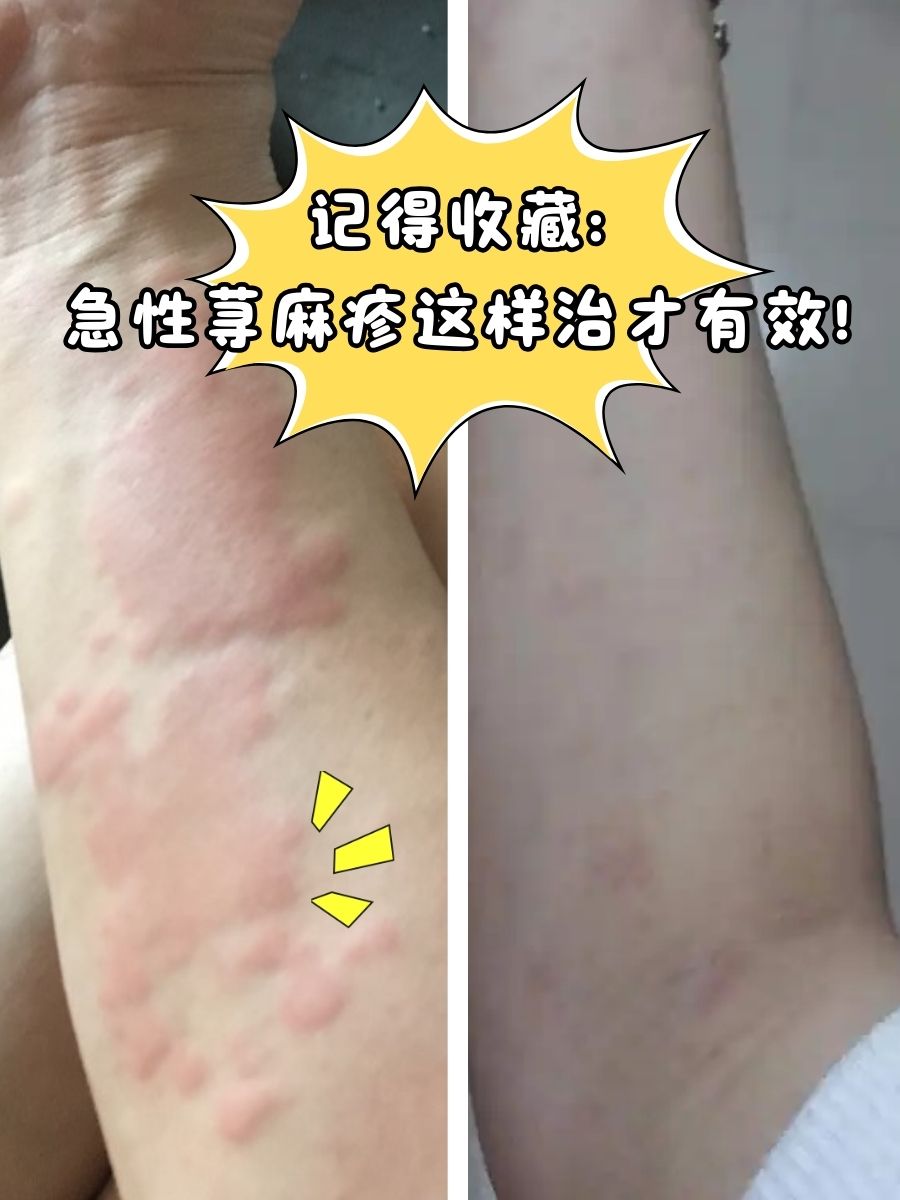 记得收藏:急性荨麻疹这样治才有效!