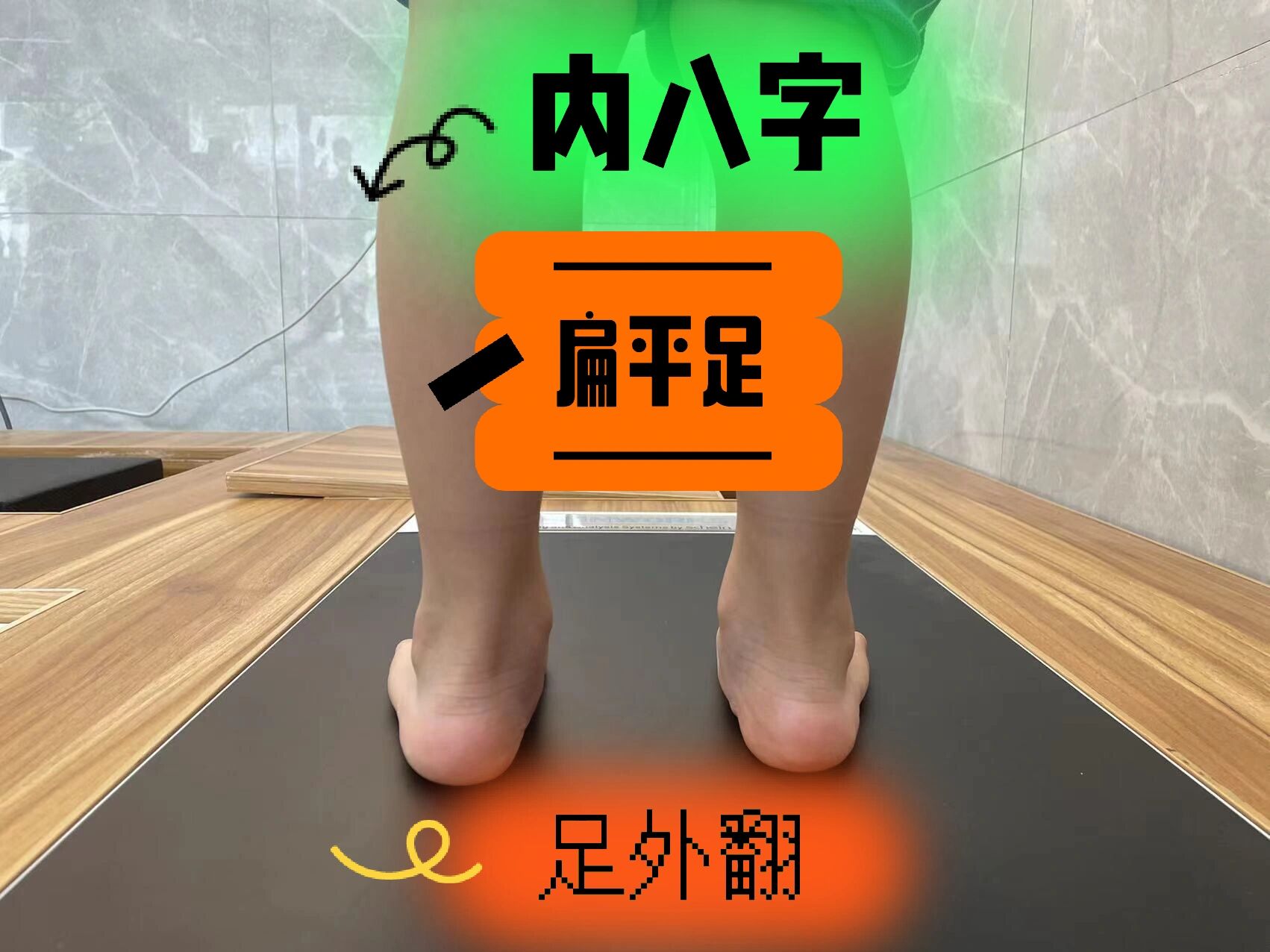 5岁男生扁平足外翻 内八字 拇外翻 屈膝走路