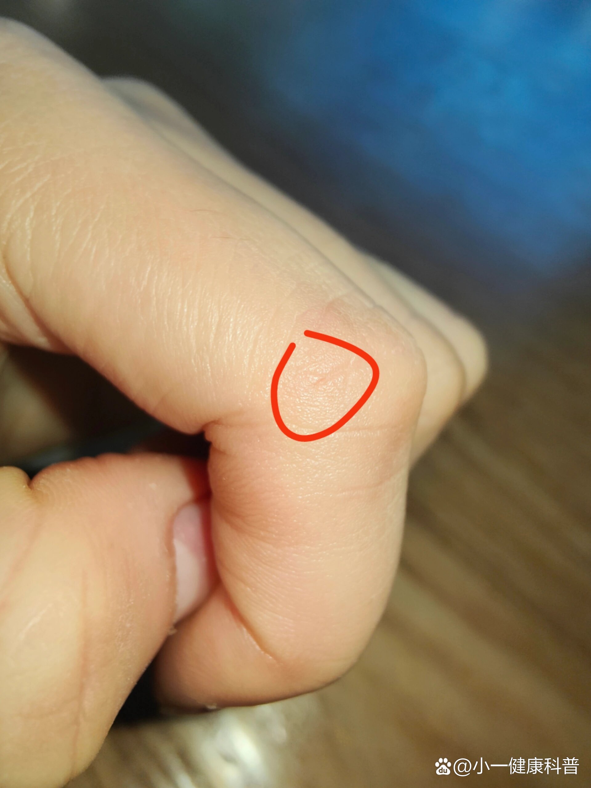 被实验室小鼠c57咬伤!