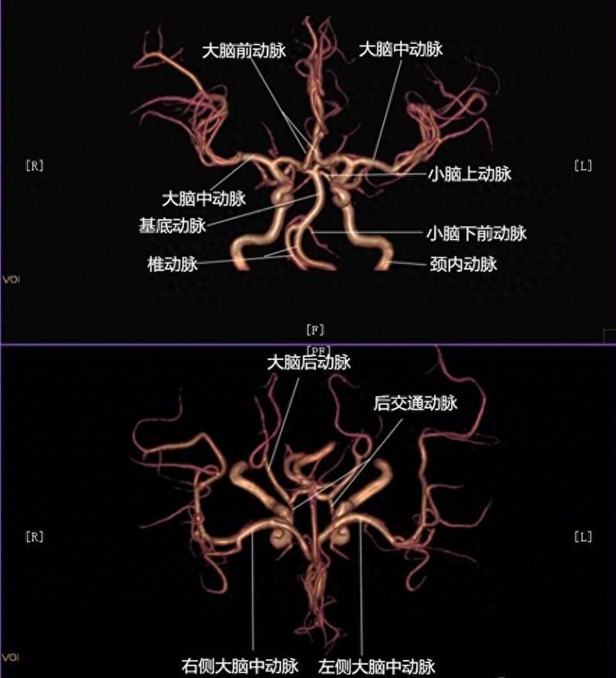 颅内血管断层解剖图图片