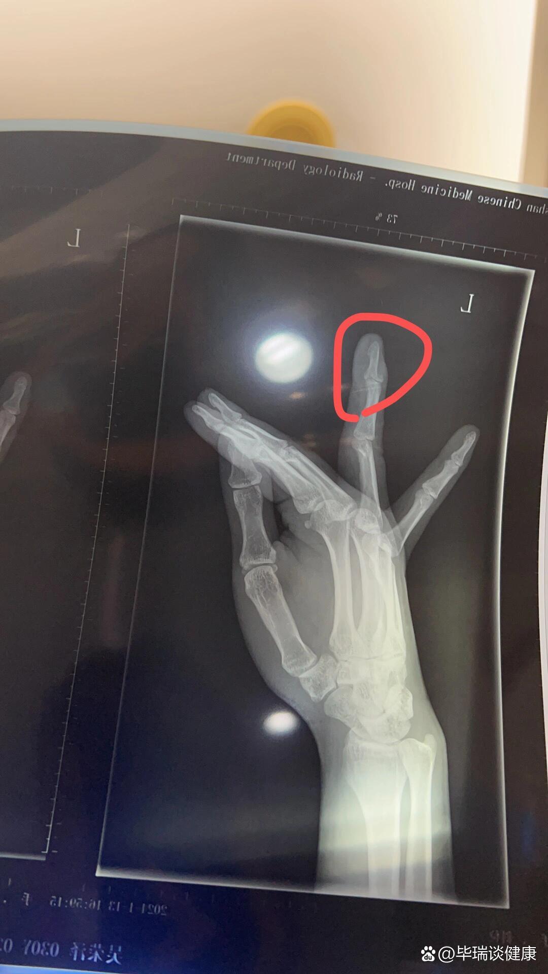 错过了最佳时机,手术了也恢复不会很好目前手指没有畸形