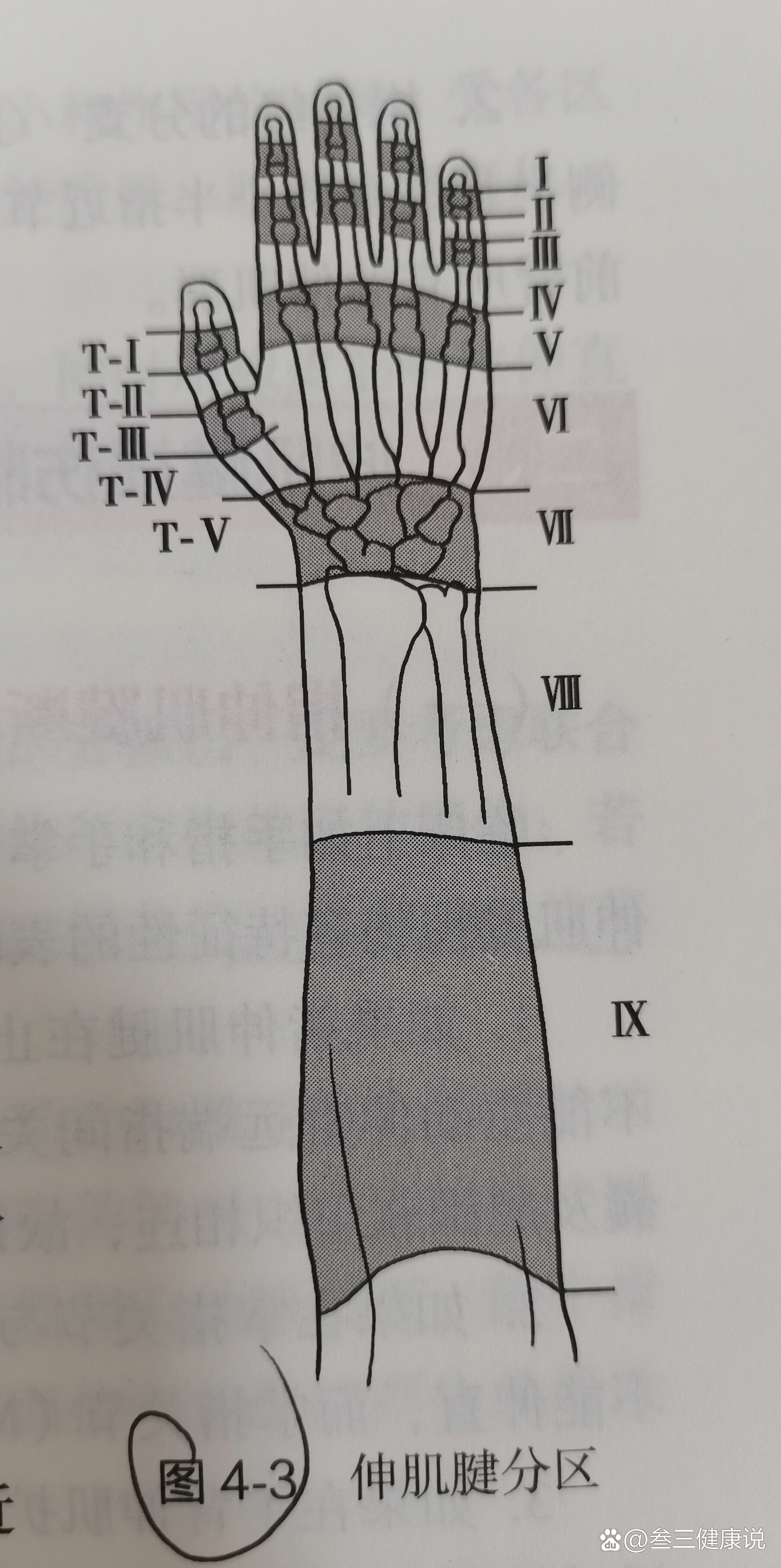 尺侧腕伸肌腱损伤图片