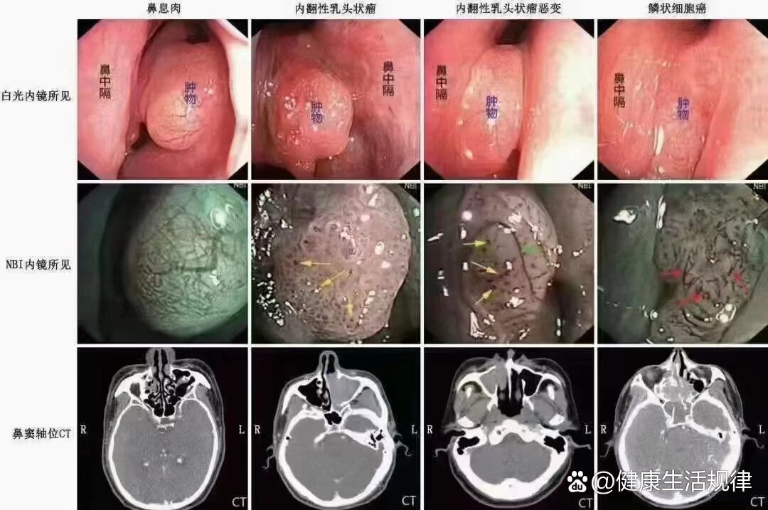 鼻息肉严重的图片图片