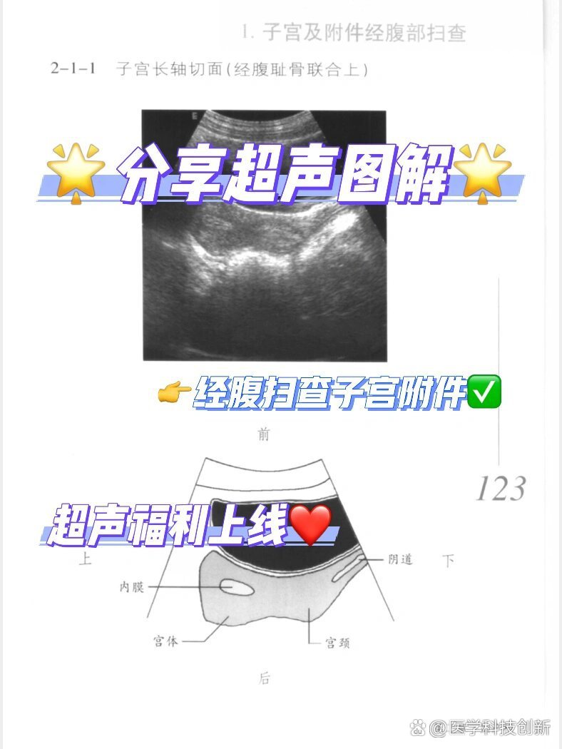 子宫附件正常图片