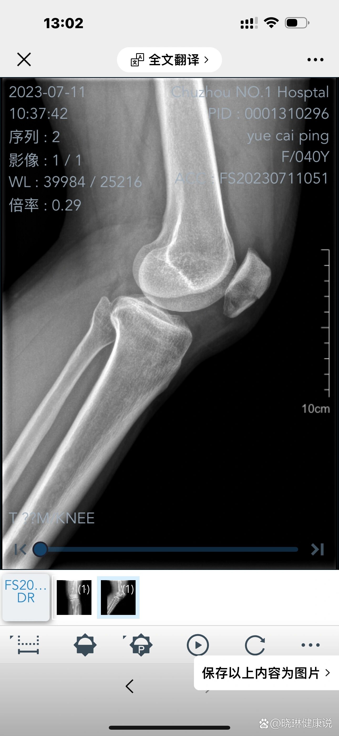 髌骨骨折图片x片图片