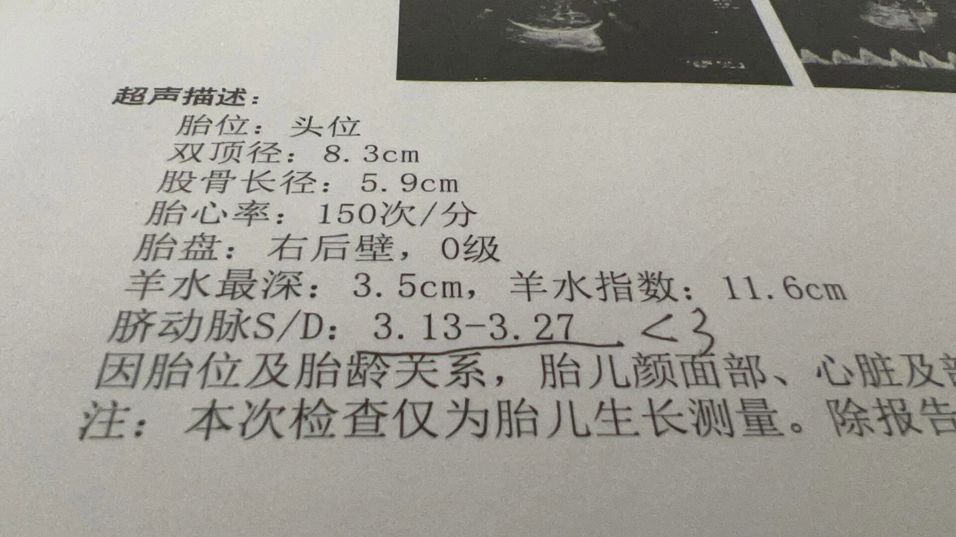 脐动脉sd值到底影响胎儿什么