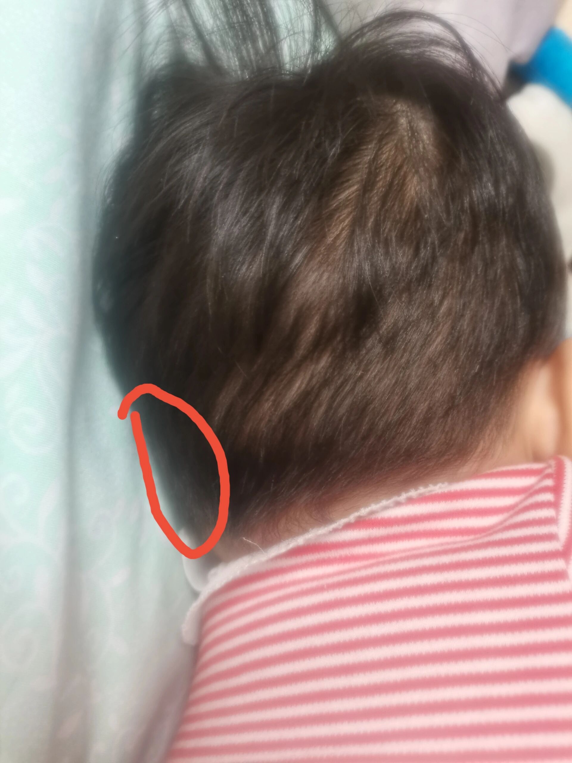 宝宝后脑勺凸出