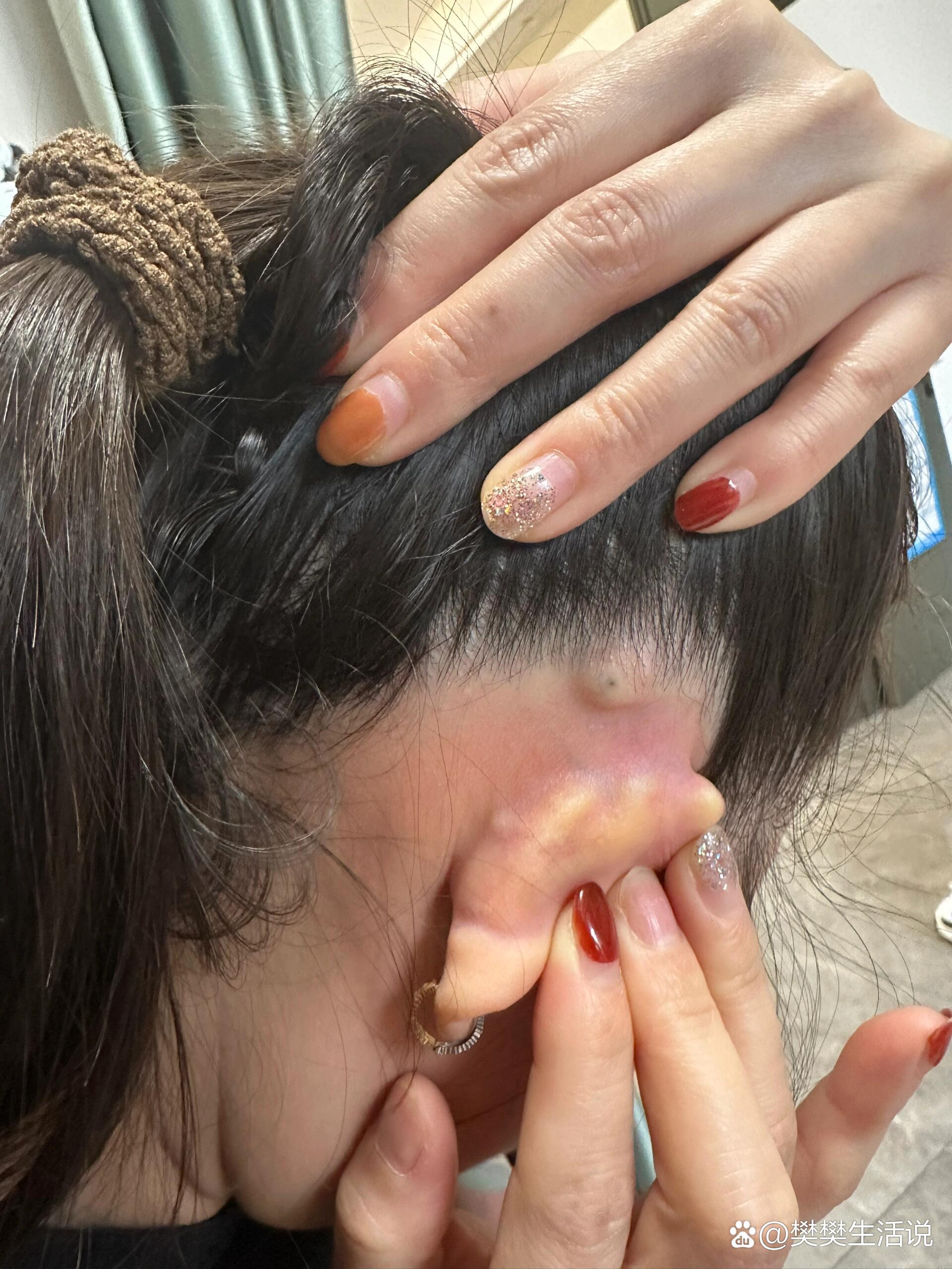 皮脂腺囊肿感染了